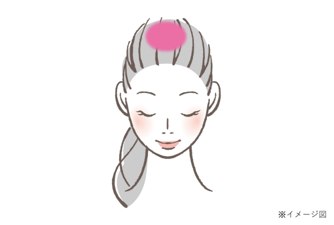 女性の壮年性脱毛症の進行パターン「ルードウィッグ型」のイメージイラスト