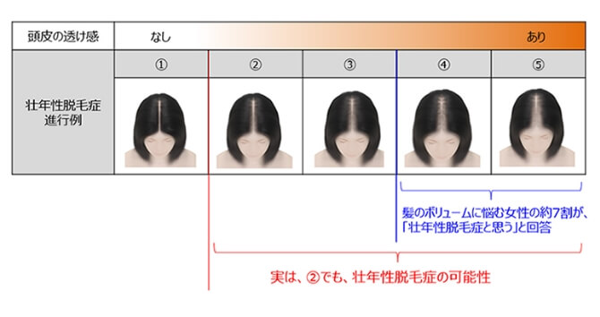 壮年性脱毛症の進行段階を5段階で表した、女性の頭頂部の分け目のイラスト
