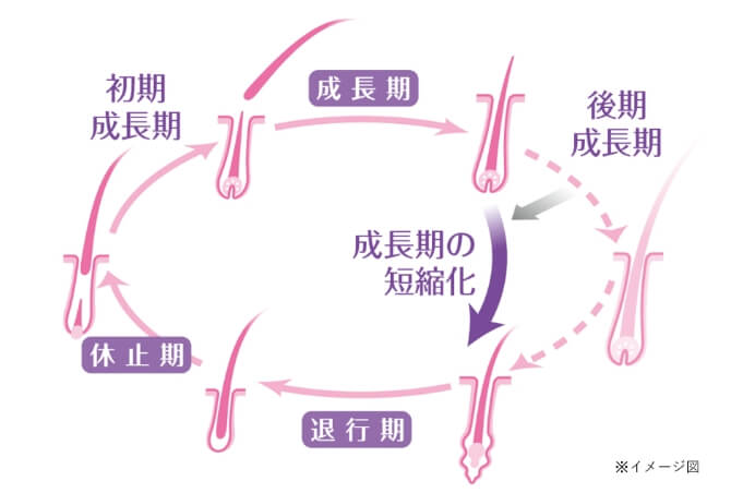 壮年性脱毛症のヘアサイクルの図。