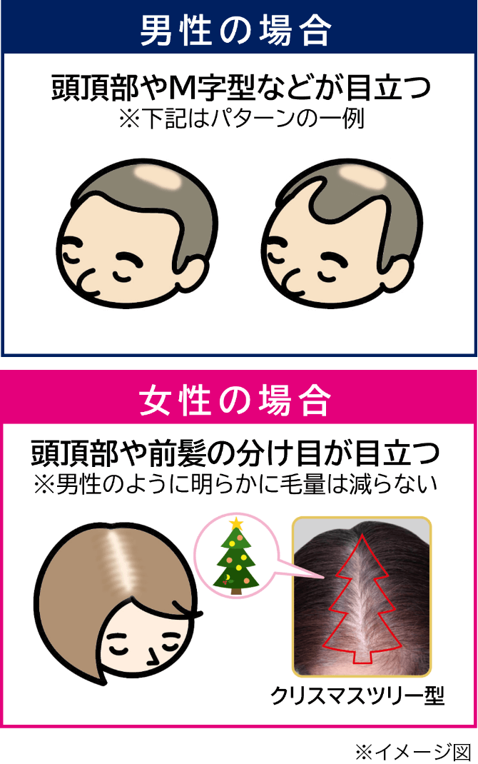 男性の壮年性脱毛症は頭頂部が薄くなる、左右のこめかみがM字型に薄くなるなどパターンが分かりやすいのに対し、女性は頭頂部の分け目のボリュームが減少したり、クリスマスツリーのような三角形に脱毛する進行パターンも見られるイメージイラスト