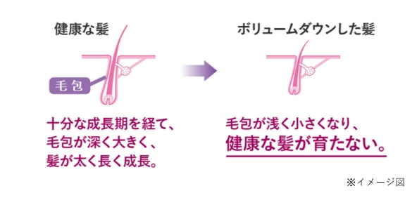 健康な髪は、十分な成長期を経て、毛包が深く大きく、髪が太く長く成長。一方、ボリュームダウンした髪は、毛包が浅く小さくなり、健康な髪が育たないことを示したイメージイラスト