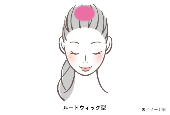 女性の壮年性脱毛症の進行パターン「ルードウィッグ型」のイメージイラスト