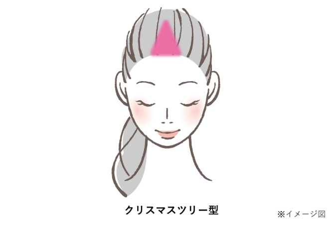 女性の壮年性脱毛症の進行パターン「クリスマスツリー型」のイメージイラスト